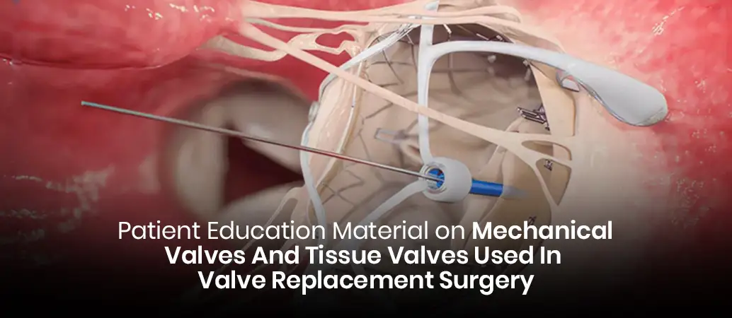 Patient Education Material On Mechanical Valves And Tissue Valves Used In Valve Replacement Surgery