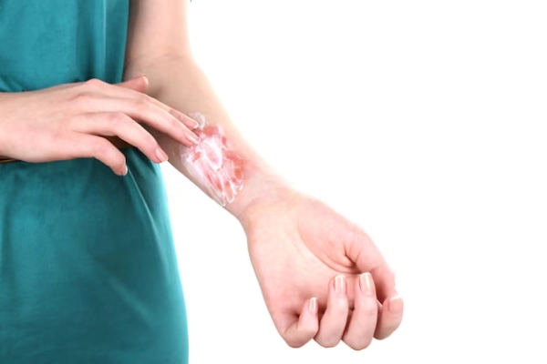 Acute Burns