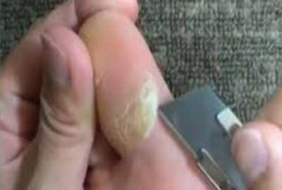 Diabetic Foot Care Donts
