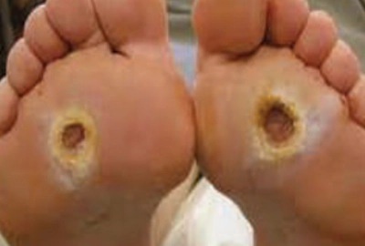 Diabetic Foot Ulcer