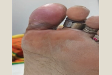 After callus shaving