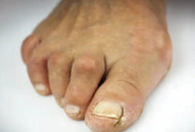 Claw toe deformity