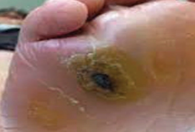 Foot callus condition