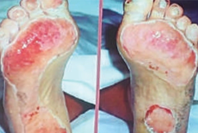 Painless neuropathy symptoms